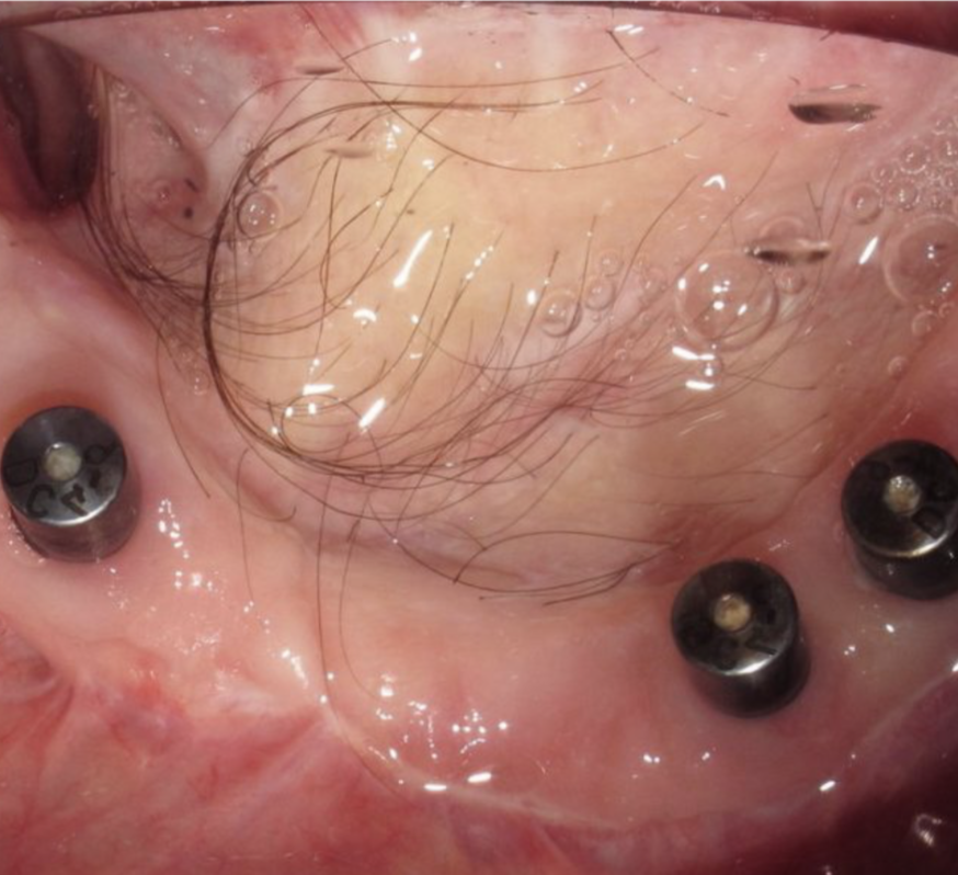 Implant-Based Oral Rehabilitation