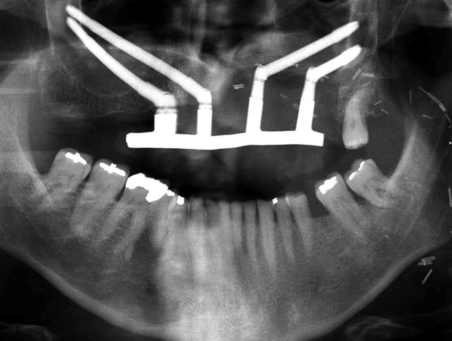 Zygomatic Implants in Head & Neck Oncology