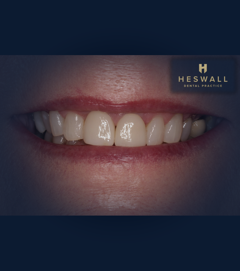 Implant outcome — Wirral Implants, Heswall Dental Practice